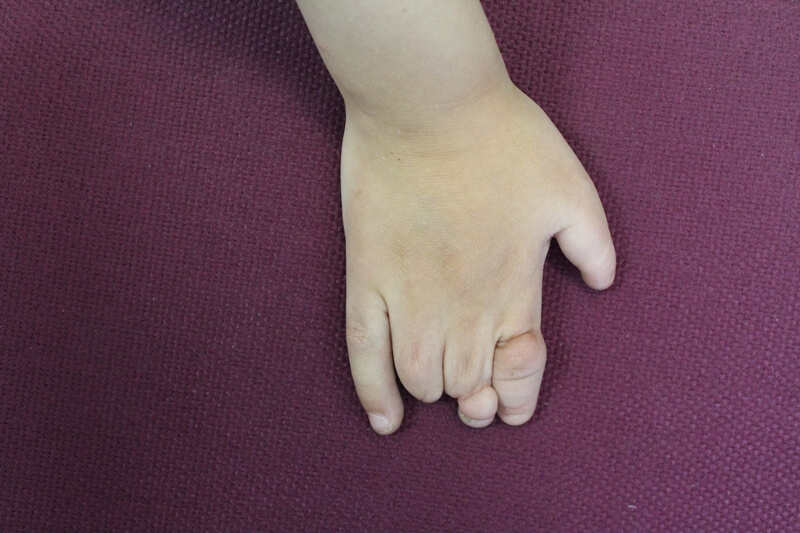 Деформация пальцев рук