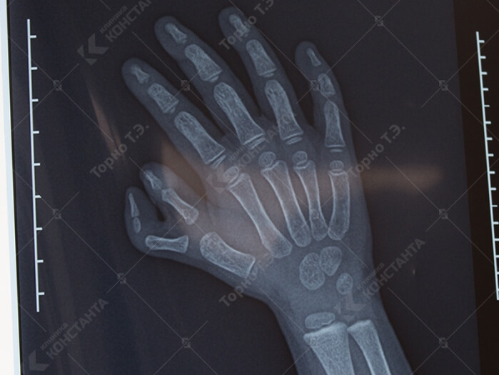 Переломы пястных костей — симптомы, диагностика, лечение в НКЦ№2 (ЦКБ РАН)