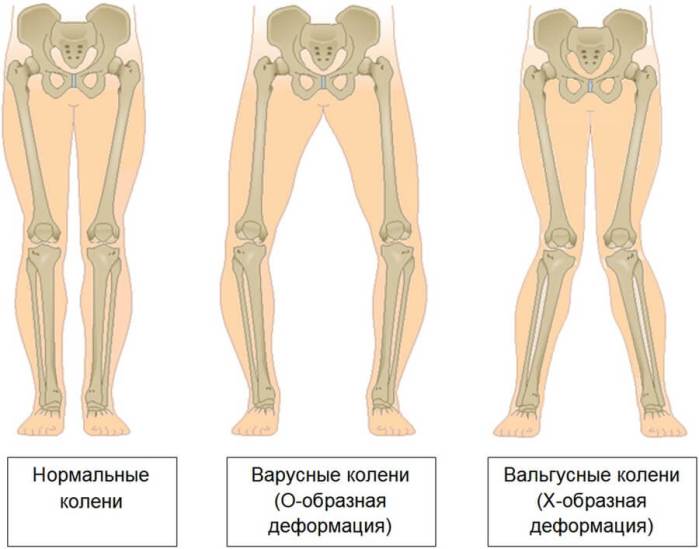Рекурвация коленных суставов